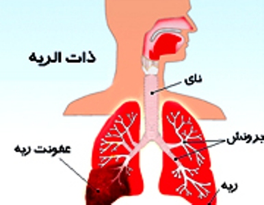 عفونت ریه